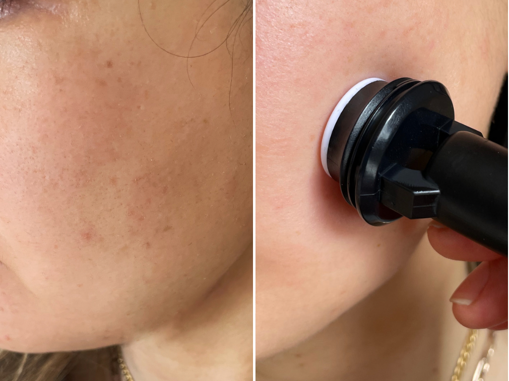 Banish acne scars before after