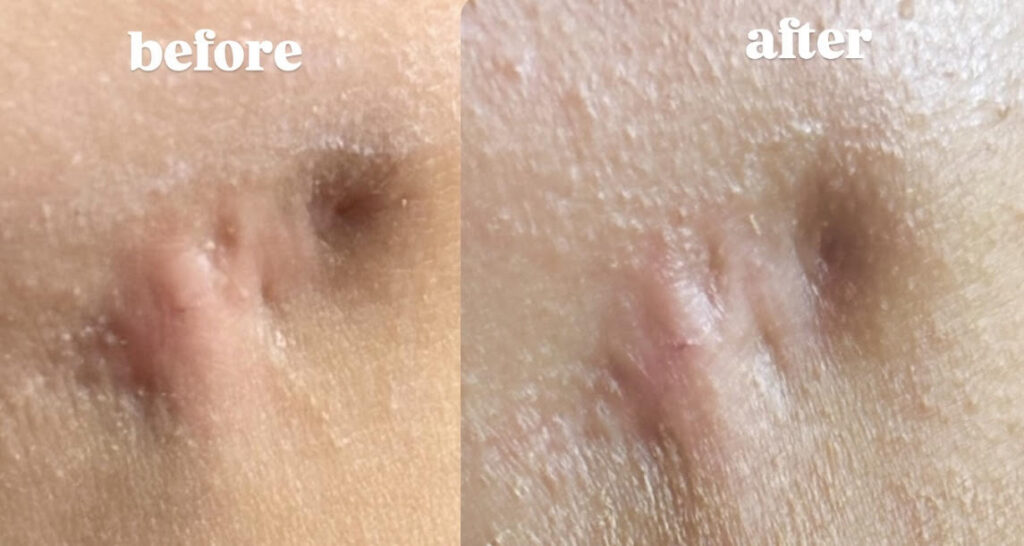Before and after 30 days of using LED Light Therapy Panel