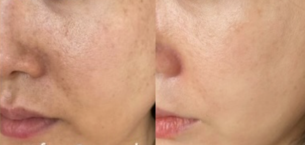 vitamin c serum Before and after six months