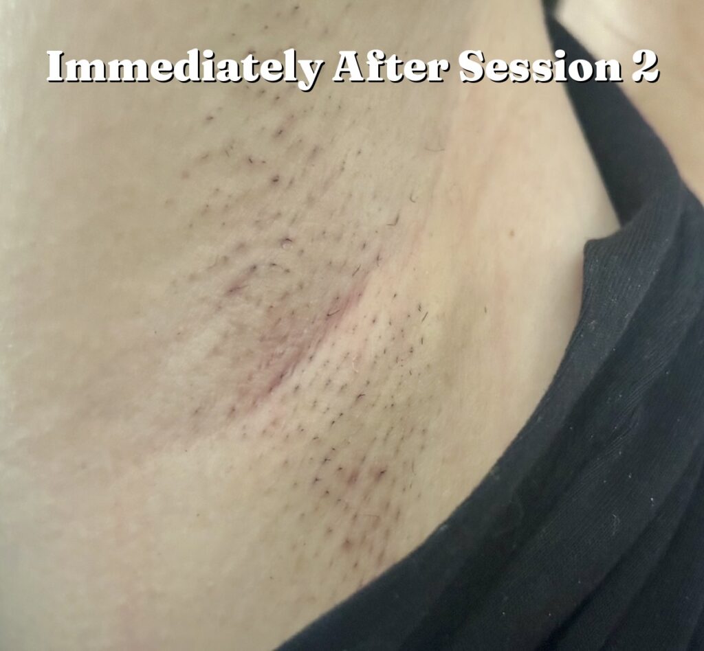 laser hair removal results before after